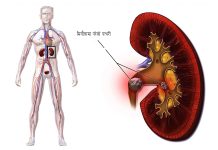 मिर्गौलाको रोगबारे जान्नैपर्ने १२ कुरा